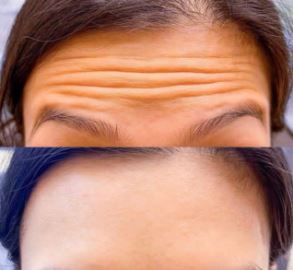 FINE LINES + WRINKLES